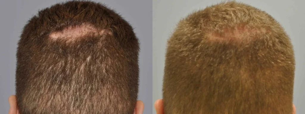 Before and after comparison of hair transplant scar healing.