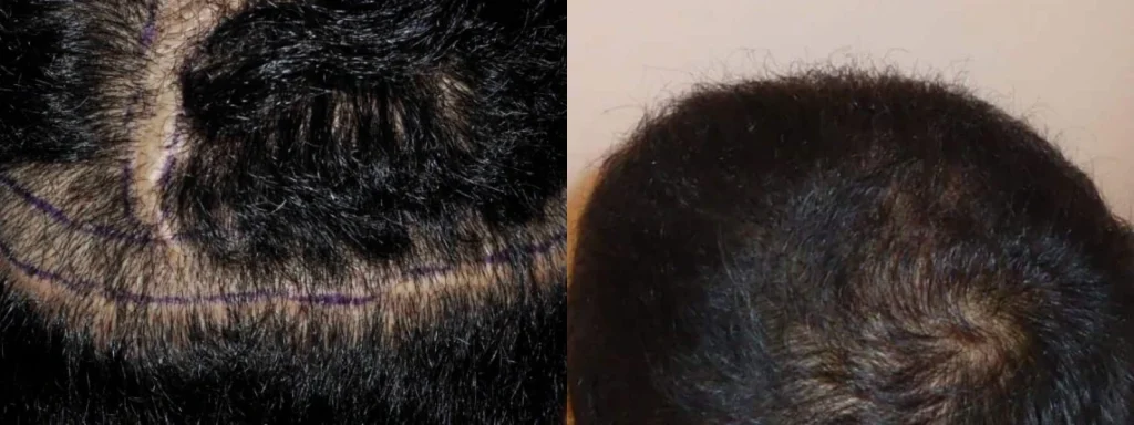 Before and after comparison of hair restoration results.