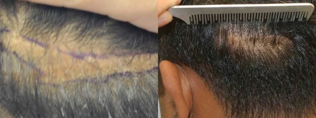 Side-by-side comparison of a scalp before and after hair restoration.