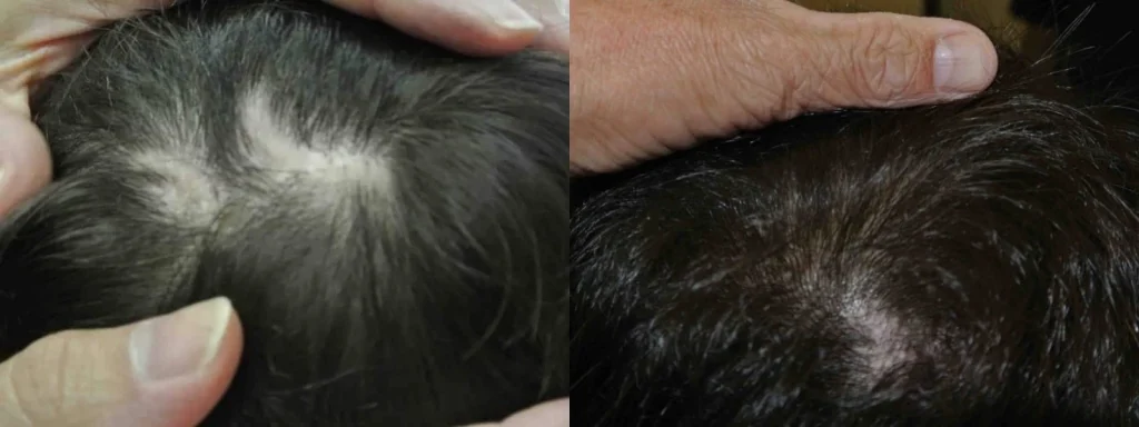Before and after comparison of scalp hair regrowth treatment.