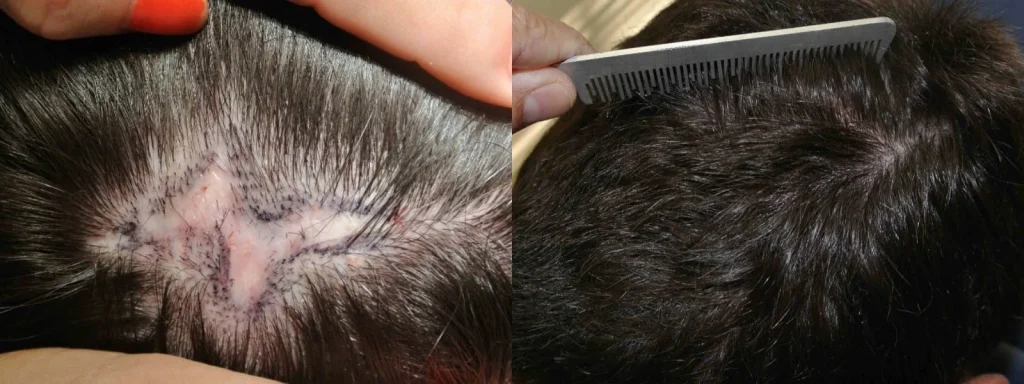 Before and after comparison of scalp micropigmentation on a scar.