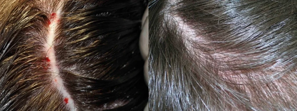 Before and after comparison of scalp irritation and healing.