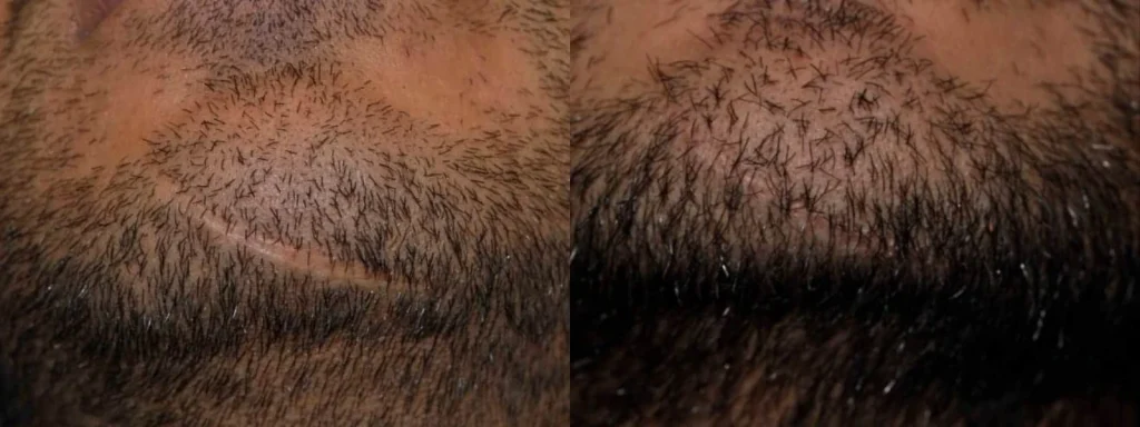 Before and after beard hair transplant covering a chin scar.