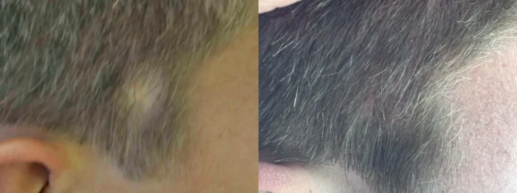 Before and after comparison of a bump on the scalp.