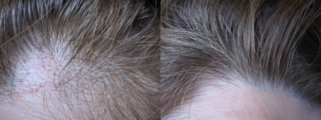 Before and after comparison of hair regrowth on a scalp.
