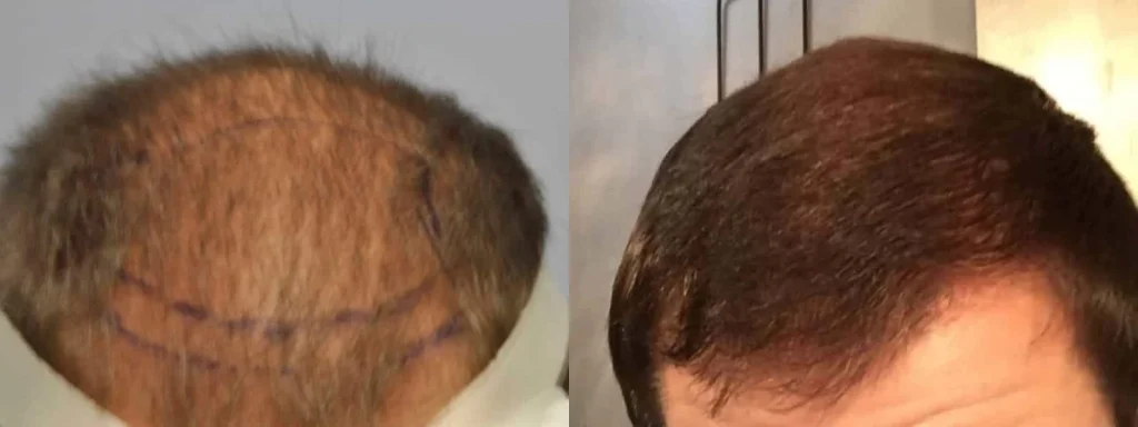Before and after comparison of a hair transplant procedure.