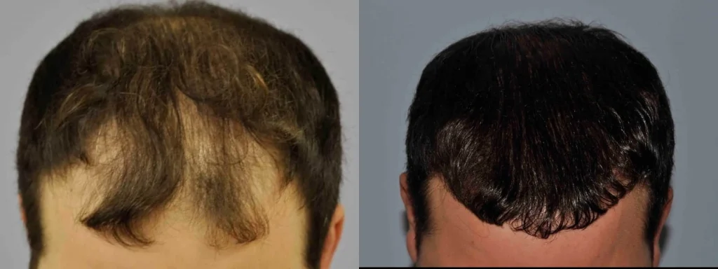 Side-by-side before and after photos of a hair transplant.