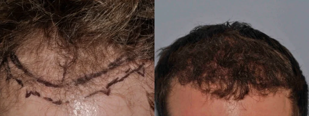 Before and after images of a hair transplant procedure.