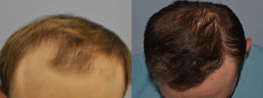 Before and after comparison of hair restoration treatment results.