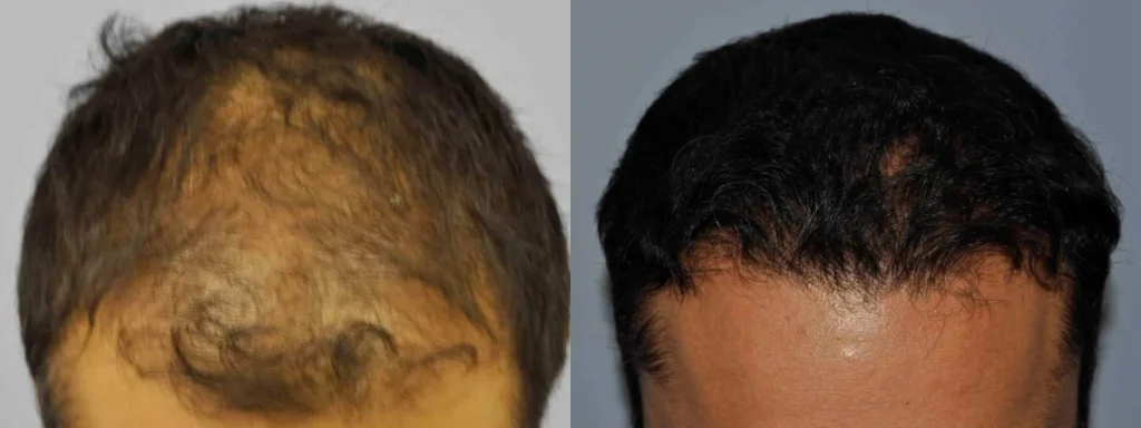 Before and after comparison of successful hair restoration treatment.
