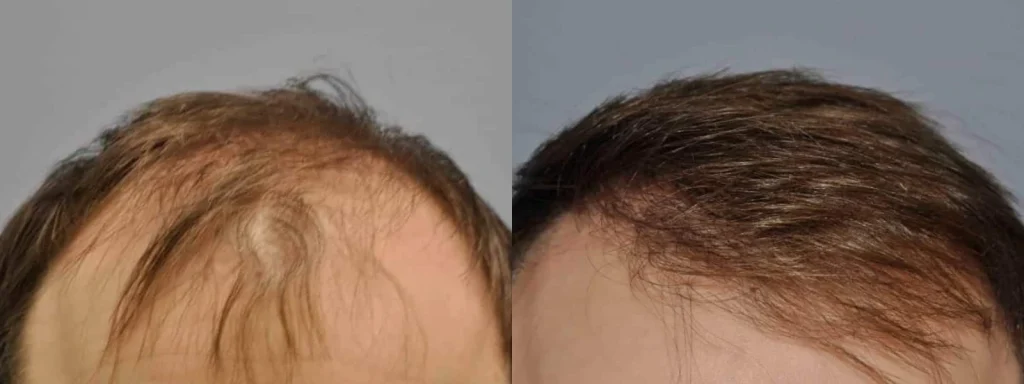 Before and after comparison of male hair restoration results.