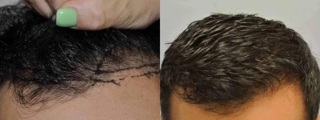 Before and after comparison of a hair transplant procedure.