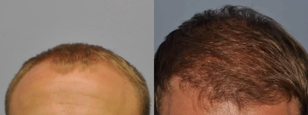 Before and after comparison of hair transplant results.