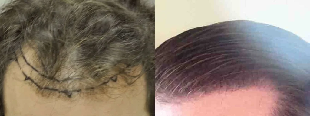 Hair transplant before and after comparison of a receding hairline.