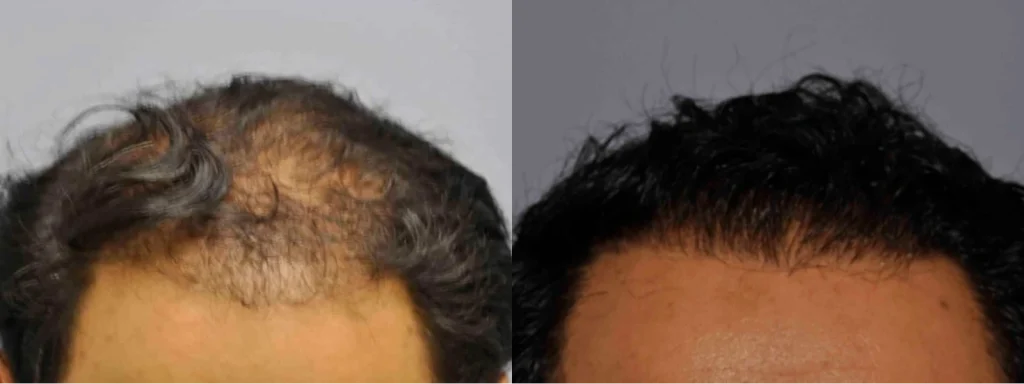 Before and after hair restoration showing fuller hairline and crown.