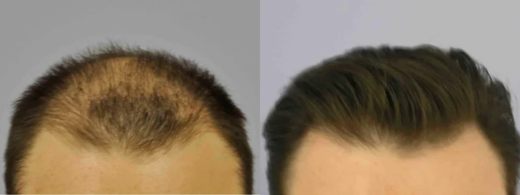 Side-by-side comparison of male hair before and after restoration.
