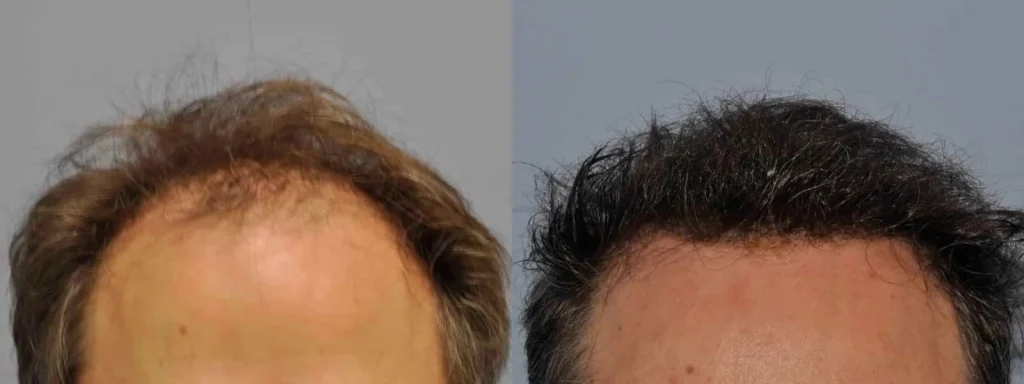 Before and after comparison of a man's hair transplant results.