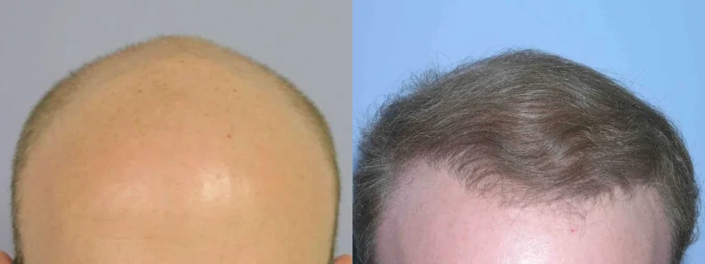 Male hair restoration before and after transformation.