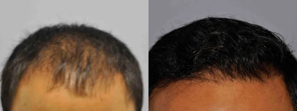 Before and after comparison of hair restoration results.