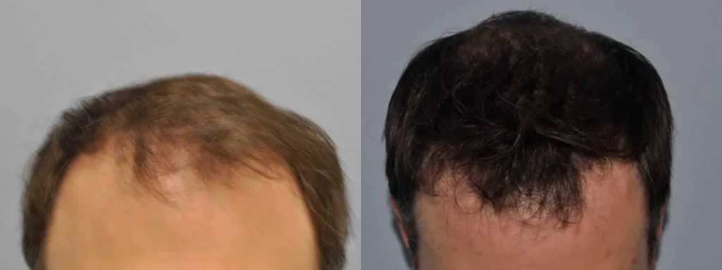 Before and after comparison of hair restoration treatment results.