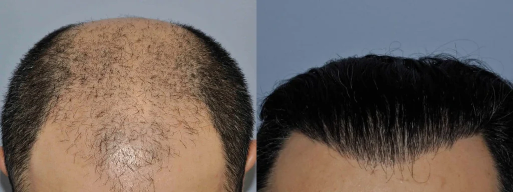 Before and after comparison of a hair transplant procedure.