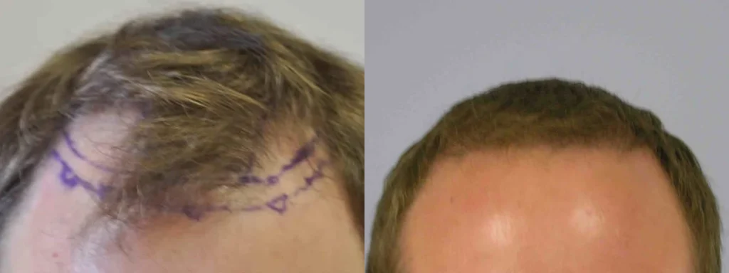 Before and after comparison of a hair transplant procedure.