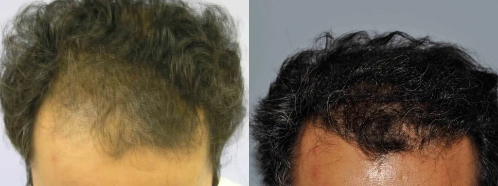Comparison of a man's hairline before and after treatment.