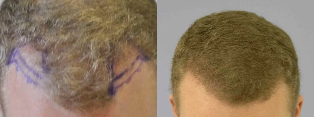 Before and after comparison of a male hair transplant.