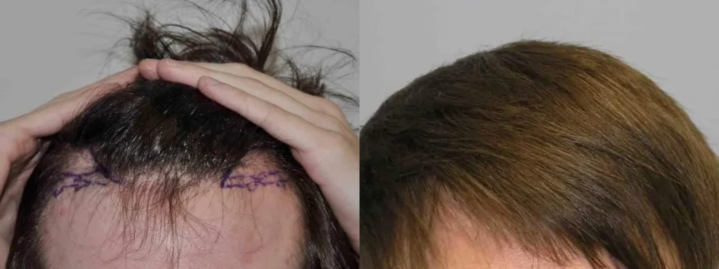 Before and after hair transplant results showing hairline restoration.
