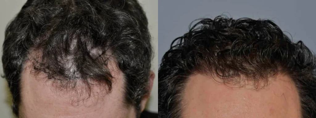 Before and after comparison of male hair restoration results.