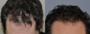 Before and after comparison of male hair restoration results.