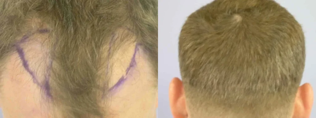 Side-by-side before and after images of a hair transplant.