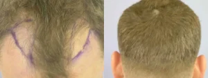 Side-by-side before and after images of a hair transplant.