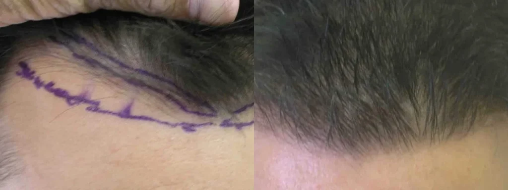 Before and after comparison of a hairline restoration procedure.