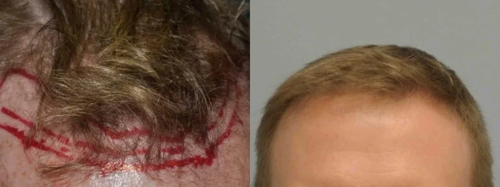 Hair transplant before and after showing restored hairline.