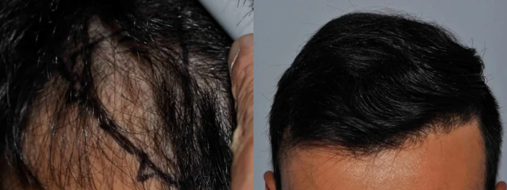 Before and after comparison of hair restoration results.
