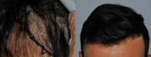 Before and after comparison of hair restoration results.