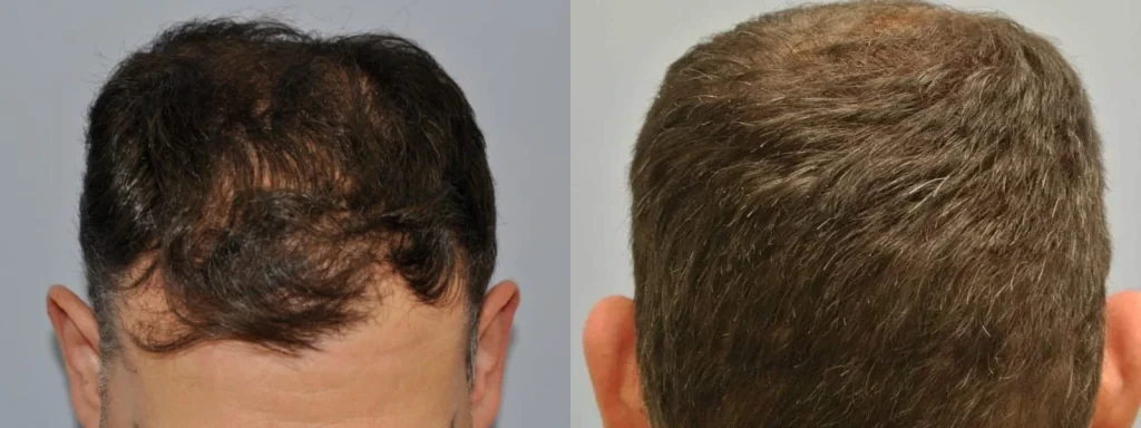 Side-by-side before and after hair transplant results for men.