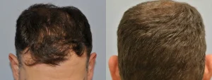 Side-by-side before and after hair transplant results for men.