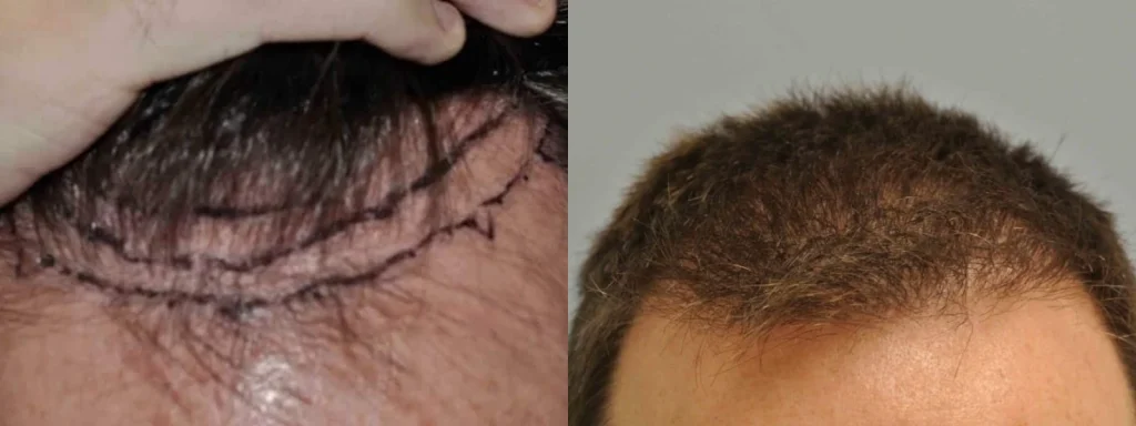 Before and after comparison of a male hair transplant procedure.