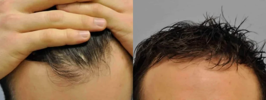 Before and after comparison of male hair restoration results.