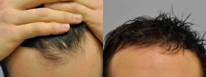 Before and after comparison of male hair restoration results.