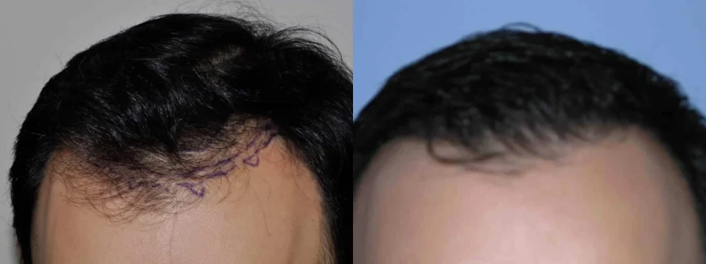 Before and after comparison of a male hair transplant result.