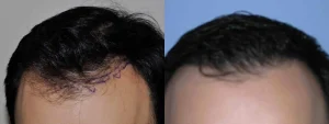 Before and after comparison of a male hair transplant result.