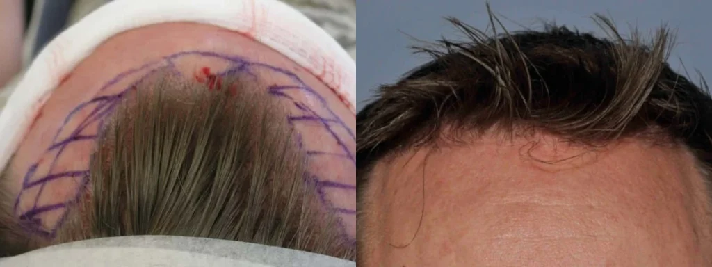 Before and after comparison of a hair transplant procedure.