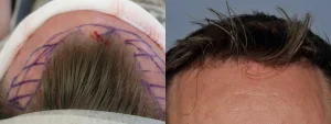 Before and after comparison of a hair transplant procedure.