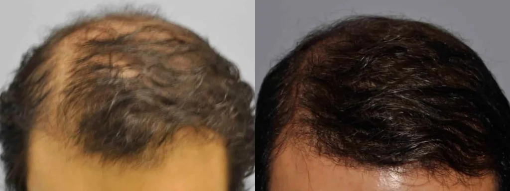 Before and after comparison of successful hair restoration results.