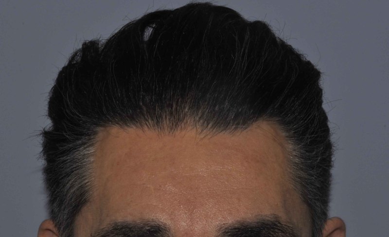 Crown and frontal restoration after 50 months
