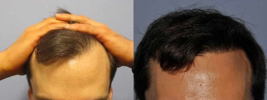 Before and after comparison of a male hair transplant result.