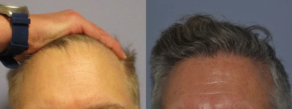 Before and after comparison of a man's hair transplant results.